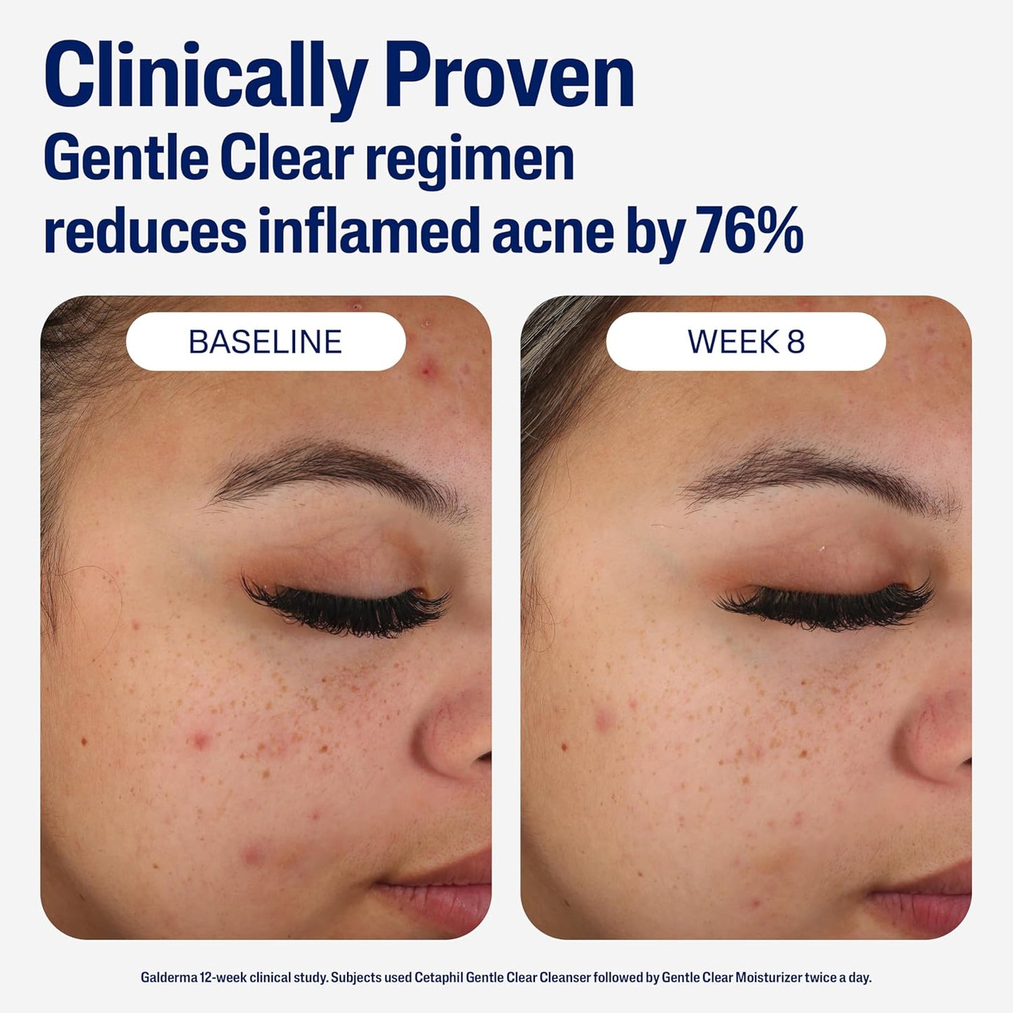 Face Moisturizer, Gentle Clear Mattifying Acne Moisturizer with 0.5% Salicylic Acid, Hydrates and Treats Sensitive Acne Prone Skin, Skin Care for Sensitive Skin, 3Oz