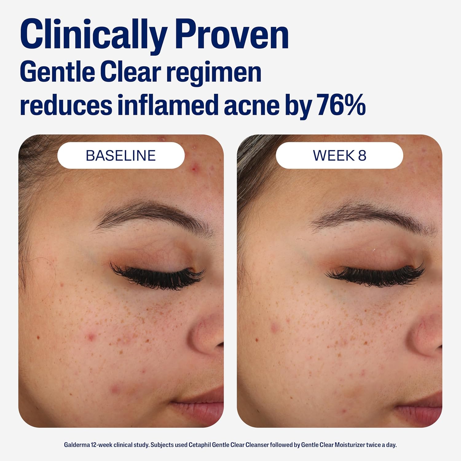 Face Moisturizer, Gentle Clear Mattifying Acne Moisturizer with 0.5% Salicylic Acid, Hydrates and Treats Sensitive Acne Prone Skin, Skin Care for Sensitive Skin, 3Oz