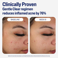 Face Moisturizer, Gentle Clear Mattifying Acne Moisturizer with 0.5% Salicylic Acid, Hydrates and Treats Sensitive Acne Prone Skin, Skin Care for Sensitive Skin, 3Oz